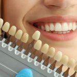 How Much Does Porcelain Lamina Veneers Cost? Porcelain Lamina Veneers