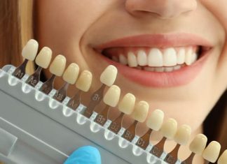 How Much Does Porcelain Lamina Veneers Cost? Porcelain Lamina Veneers