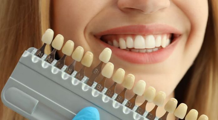 Porcelain Lamina Veneers