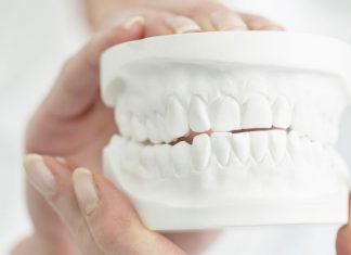 Invisalign: Experiences After Two Months Invisalign