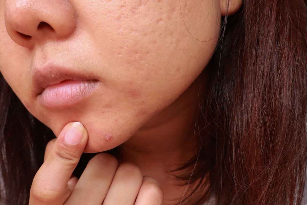 From Acne Scars to Sun Damage Effective Ways to Fade Dark Spots The