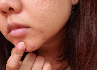 Acne scar