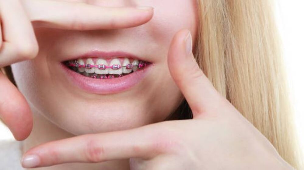 Benefits of Personalized Braces