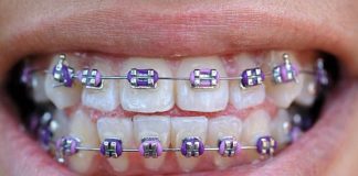 Personalize Your Smile with Pink and Purple Braces