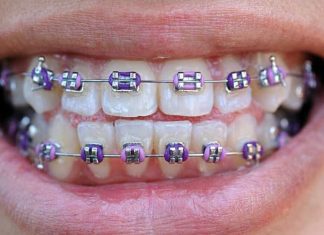 Personalize Your Smile with Pink and Purple Braces