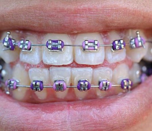 Personalize Your Smile with Pink and Purple Braces