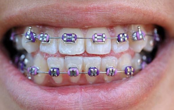 Personalize Your Smile With Pink And Purple Braces The European