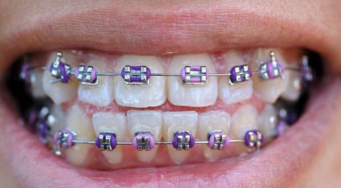 Personalize Your Smile with Pink and Purple Braces