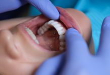 Doctor dentist examining patient oral cavity with veneers closeup