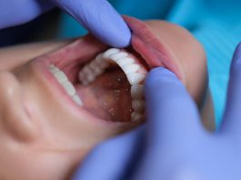 Doctor dentist examining patient oral cavity with veneers closeup