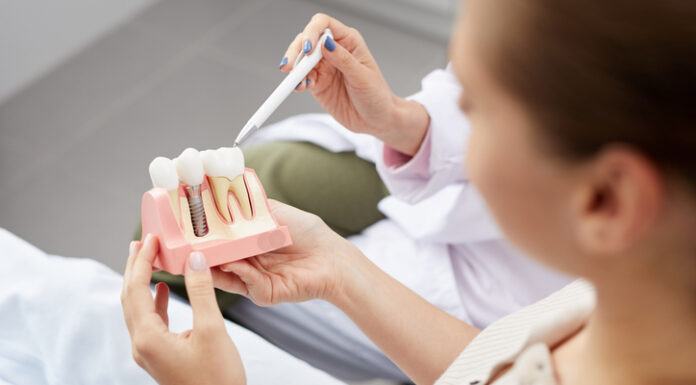 Dental Implants