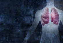 Mesothelioma Is Linked to Asbestos Exposure