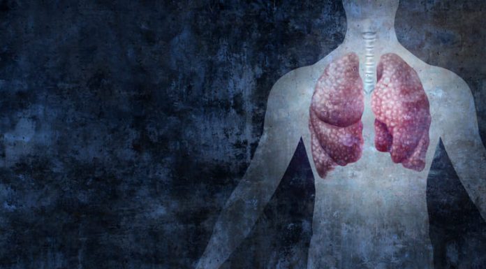 Mesothelioma Is Linked to Asbestos Exposure