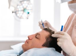 Closeup side view of unrecognizable female nurse drawing using pencil new hairline on head of patient male before hair transplantation surgery in clinic. Concept of professional baldness treatment.