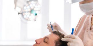 Closeup side view of unrecognizable female nurse drawing using pencil new hairline on head of patient male before hair transplantation surgery in clinic. Concept of professional baldness treatment.