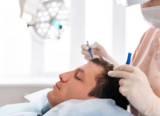 Closeup side view of unrecognizable female nurse drawing using pencil new hairline on head of patient male before hair transplantation surgery in clinic. Concept of professional baldness treatment.