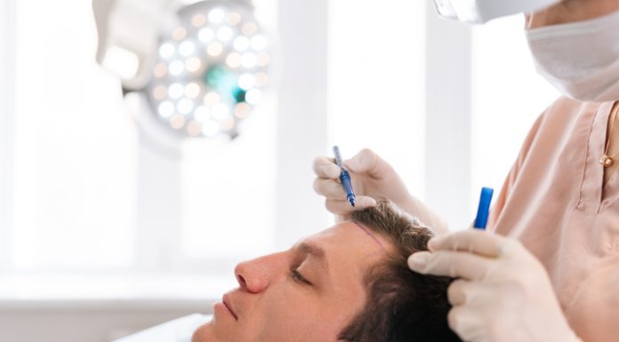 Closeup side view of unrecognizable female nurse drawing using pencil new hairline on head of patient male before hair transplantation surgery in clinic. Concept of professional baldness treatment.