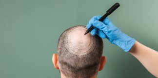 10 Top-Rated Hair Transplant Centers in Istanbul You Can Trust in 2026 Trichologist outlines the area of baldness on the client's head with a marker. Rear view. Green background. The concept of alopecia and mesotherapy.