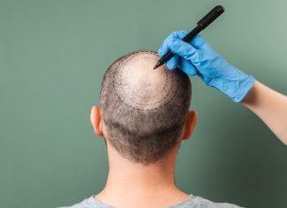 10 Top-Rated Hair Transplant Centers in Istanbul You Can Trust in 2026 Trichologist outlines the area of baldness on the client's head with a marker. Rear view. Green background. The concept of alopecia and mesotherapy.