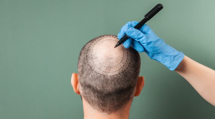 10 Top-Rated Hair Transplant Centers in Istanbul You Can Trust in 2026 Trichologist outlines the area of baldness on the client's head with a marker. Rear view. Green background. The concept of alopecia and mesotherapy.