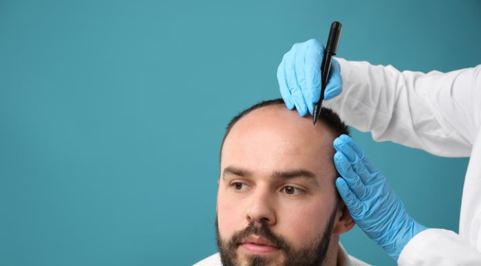 Top 10 Clinics with the Best Before-and-After Hair Transplant Results — Verified by Patients Baldness problem. Doctor in medical gloves drawing marks on patient's head before hair transplant surgery