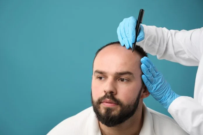 Baldness problem. Doctor in medical gloves drawing marks on patient's head before hair transplant surgery against light blue background, closeup. Space for text Baldness problem. Doctor in medical gloves drawing marks on patient's head before hair transplant surgery